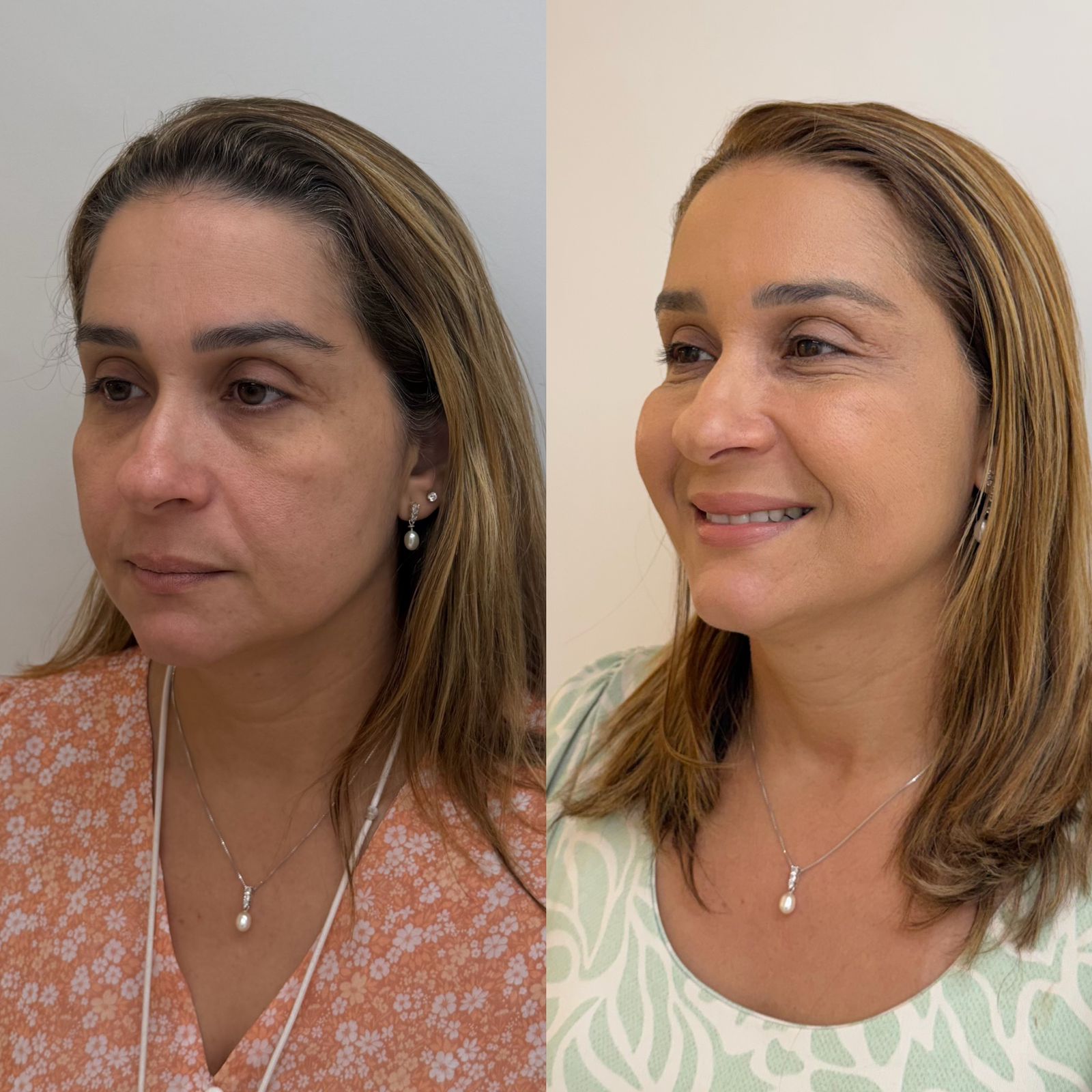 Harmonização Full Face em Fortaleza — Dra. Charlotte Oliveira