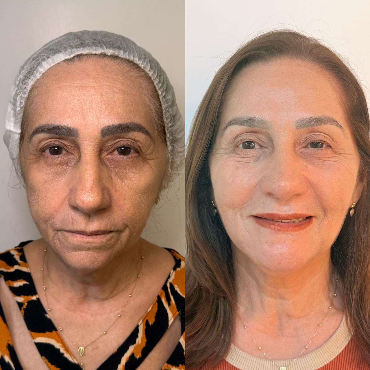 Harmonização Full Face em Fortaleza — Dra. Charlotte Oliveira