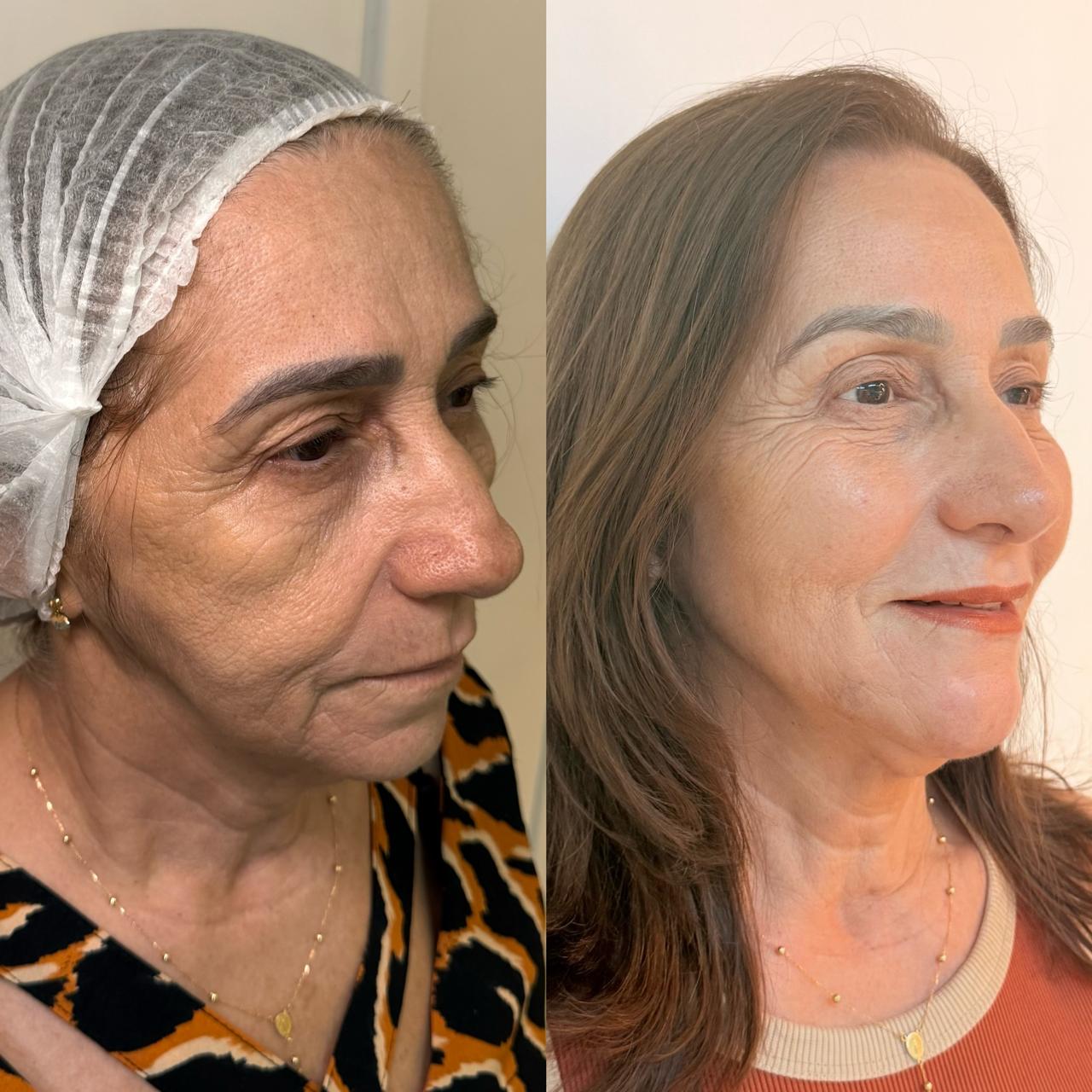 Harmonização Full Face em Fortaleza — Dra. Charlotte Oliveira