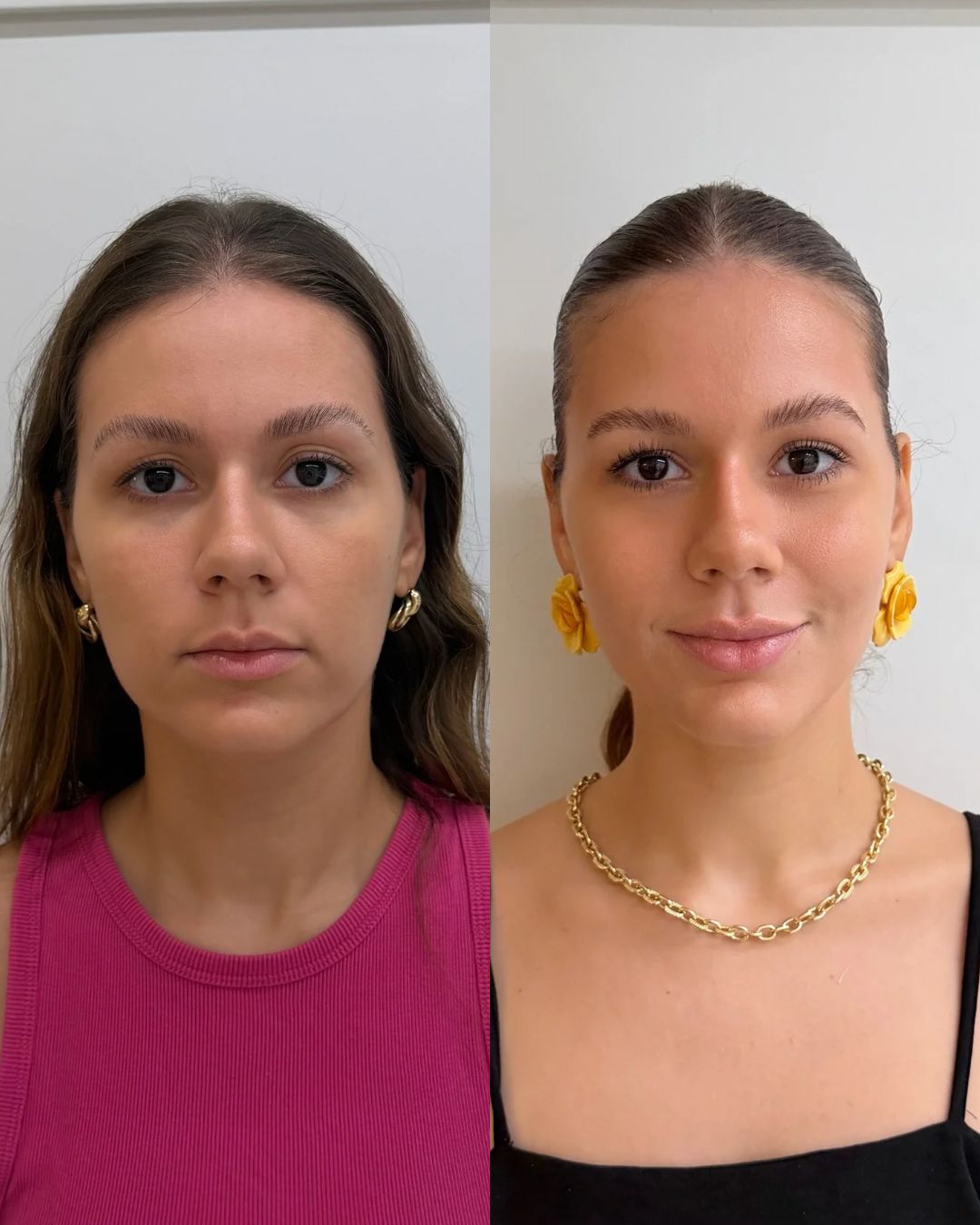 Harmonização Full Face em Fortaleza — Dra. Charlotte Oliveira