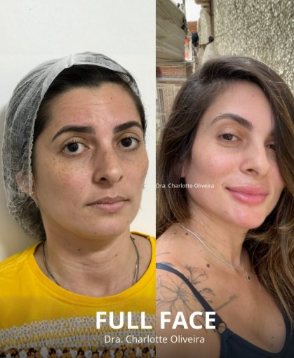 Harmonização Full Face em Fortaleza — Dra. Charlotte Oliveira