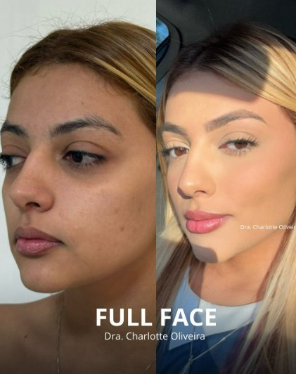Harmonização Full Face em Fortaleza — Dra. Charlotte Oliveira