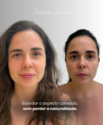 Rejuvenescimento Natural em Fortaleza — Dra. Charlotte Oliveira