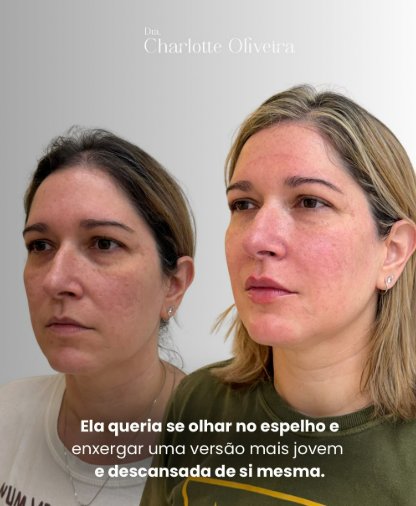 Rejuvenescimento Natural em Fortaleza — Dra. Charlotte Oliveira